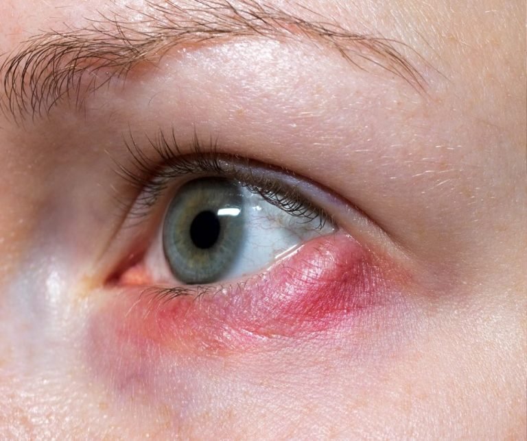 Jęczmień na oku